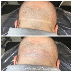 Scottsdale Head - Scar camouflage at scottsdale head Hairloss clinic