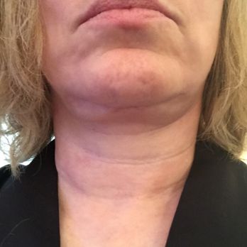 Christopher A Park, MD - Post facelift 6 months post op - Cosmetic Surgeons Near Me - Mobile, Alabama