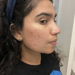 Sangini Patel, M.S, PA-C - Liv Aesthetics - 30 days post treatment