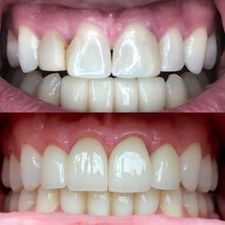 Renew Dental - My new teeth!