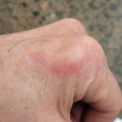 Sprouts Farmers Market - Injuries from ladder on cart.