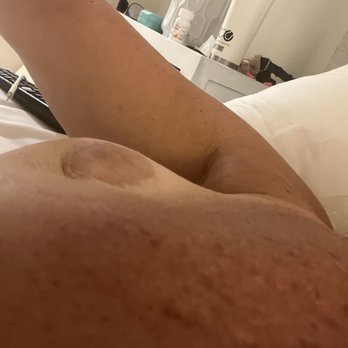 Orange County Plastic Surgery - Implant slide under my armpit - Cosmetic Surgeons Near Me - Corona del Mar, California Orange County Plastic Surgery - Implant slide under my armpit - Cosmetic Surgeons Near Me - Corona del Mar, California