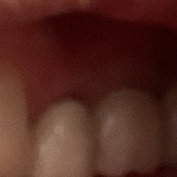 Bright Now Dental & Orthodontics - Poor crown w 1/8 inch black line at the gum. Dr. Please fix this. Also, a mirror at the time of procedures would have prevented this post.