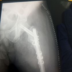 Huntsville Hospital - After dr griffin redid the surgery correctly im so thankful that he was able correct what dr maples did