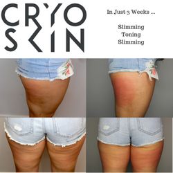Flow Cryotherapy - Alternating between CryoSlimming and CryoToning- Female before and after