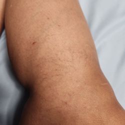 USA Vein Clinics - Varicose Veins problem made worst