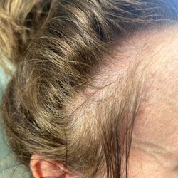 AN Beauty Salon - Have bald spots worse on sides she killed hair follicles never will grow back