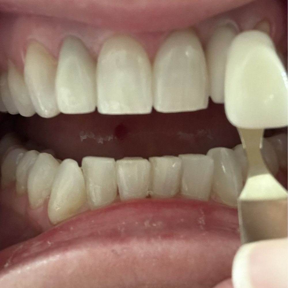 Epic-White - After she whitened my teeth!! So white and bright !!! - Teeth Whitening Near Me - Murrieta, California Epic-White - After she whitened my teeth!! So white and bright !!! - Teeth Whitening Near Me - Murrieta, California