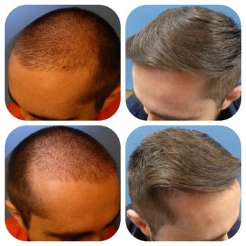 Meshkin Medical - Class four with 3000 grafts - Hair Loss Centers Near Me - Glendale, California Meshkin Medical - Class four with 3000 grafts - Hair Loss Centers Near Me - Glendale, California