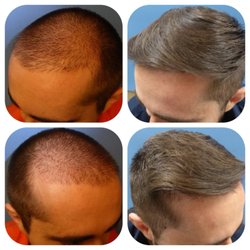 Meshkin Medical - Class four with 3000 grafts
