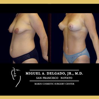 Miguel Delgado, M.D - Mommy makeover: We also specialize in facelifts, tummy tucks, breast augmentation implant surgery, breast revisions,gynecomastia & eyelids. - Cosmetic Surgeons Near Me - San Francisco, California Miguel Delgado, M.D - Mommy makeover: We also specialize in facelifts, tummy tucks, breast augmentation implant surgery, breast revisions,gynecomastia & eyelids. - Cosmetic Surgeons Near Me - San Francisco, California