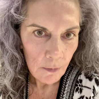 Alexus Surgery Center & Medspa - The aftermath of today's facial! - Cosmetic Surgeons Near Me - San Diego, California Alexus Surgery Center & Medspa - The aftermath of today's facial! - Cosmetic Surgeons Near Me - San Diego, California