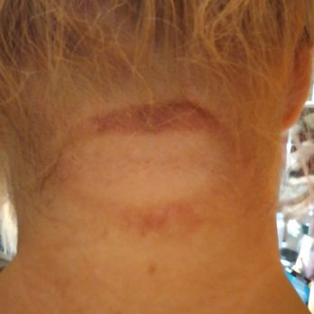 American Beauty School - First burn pic. Had puss seeping and was swollen above and below indentation. - Cosmetology Schools Near Me - Bronx, New York American Beauty School - First burn pic. Had puss seeping and was swollen above and below indentation. - Cosmetology Schools Near Me - Bronx, New York