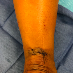 Oliver Schipper, MD - Minimally invasive achilles repair (PARS technique)