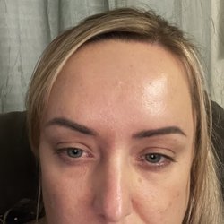 The Botox Lounge - After