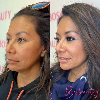 BosBeauty - Before on the left. - Skin Care Near Me - Las Vegas, Nevada BosBeauty - Before on the left. - Skin Care Near Me - Las Vegas, Nevada