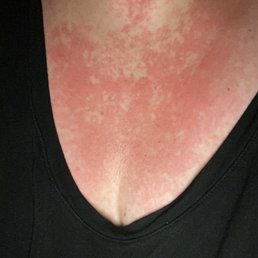 Adverse reaction to Lindora infections and supplements Adverse reaction to Lindora infections and supplements