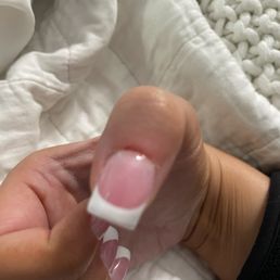 Scabbed cuticles Scabbed cuticles