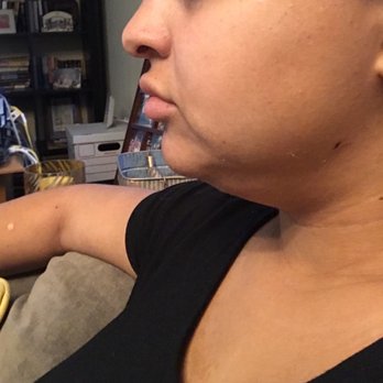 Bui Hoang MD - Before - Cosmetic Surgeons Near Me - Orange, California