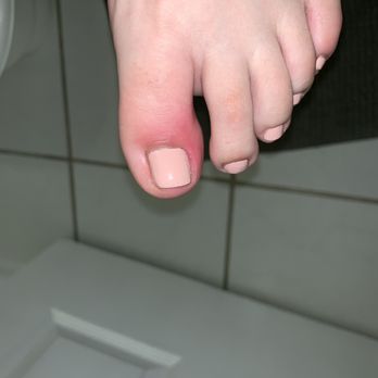 P Nails - Severe infection caused by over cutting cuticle and beyond dirty clippers. - Nail Salons Near Me - Los Angeles, California
