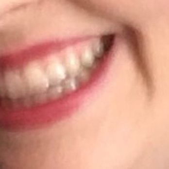 Setian Saro, DDS - After Invisalign! - General Dentistry Near Me - Torrance, California Setian Saro, DDS - After Invisalign! - General Dentistry Near Me - Torrance, California