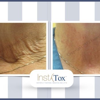 Complexions MD - Instatox Neck - Medical Spas Near Me - Huntington, New York