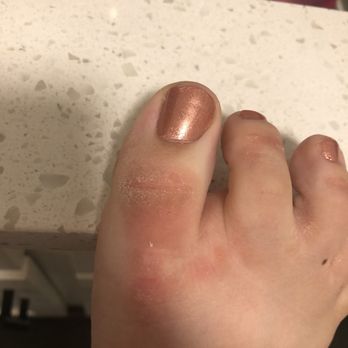 1 For My Nails - The raw rash from an ACTUAL CHEESE GRATER. - Nail Salons Near Me - Midvale, Utah