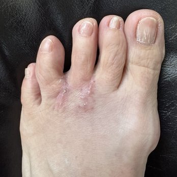 Lincoln Surgery Center - Picture of my left foot a little over a month after my Morton's neuroma surgery - Surgeons Near Me - Parker, Colorado Lincoln Surgery Center - Picture of my left foot a little over a month after my Morton's neuroma surgery - Surgeons Near Me - Parker, Colorado