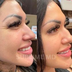Sublime Medical Aesthetics - Address crows feet around the eyes with Botox