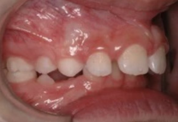 Case 5 - This patient had an overbite with spacing. To fix this, I recommended braces and Mara appliance. Case 5 - This patient had an overbite with spacing. To fix this, I recommended braces and Mara appliance.