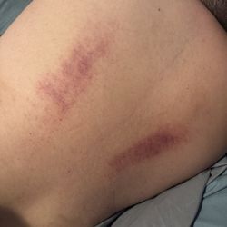 Gold Leaf Foot Spa - Bruises from service