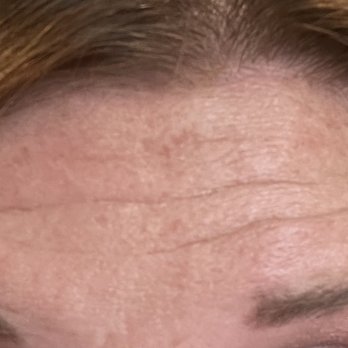 Mountain View Aesthetics - Wrinkles on forehead have slight improvement. 2 weeks post Botox - Skin Care Near Me - Westminster, Colorado Mountain View Aesthetics - Wrinkles on forehead have slight improvement. 2 weeks post Botox - Skin Care Near Me - Westminster, Colorado