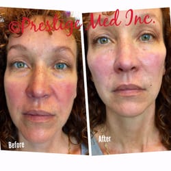Prestige Med - Areas treated - under eyes, cheeks, and NLFs.            Thank you dear patient for allowing us to share your results here.