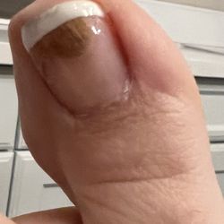 Toe fungus