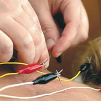 Mental Wellness Acupuncture - Acupuncture Near Me - Tustin, California Mental Wellness Acupuncture - Acupuncture Near Me - Tustin, California