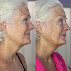 The Skin Whisperer - Results from just one face treatment! This could be you too, book now and be ready for the holidays!