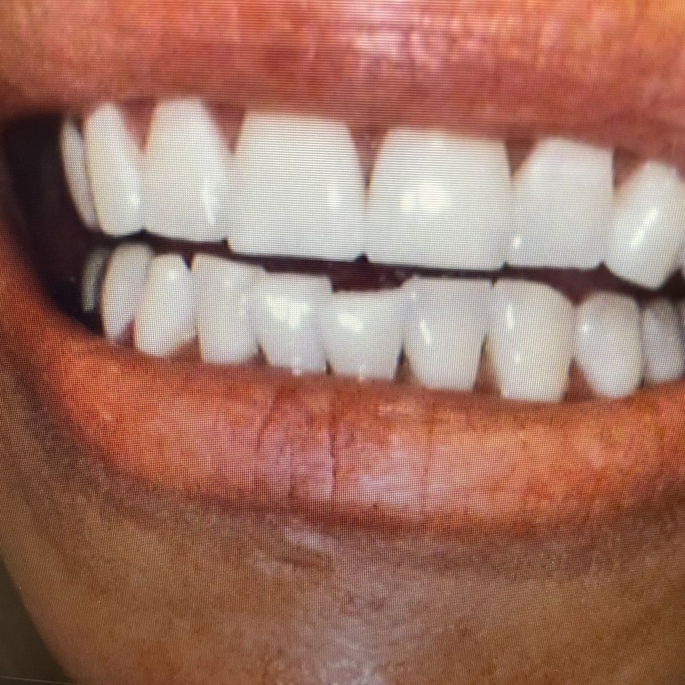 Before and after Zoom whitening Before and after Zoom whitening