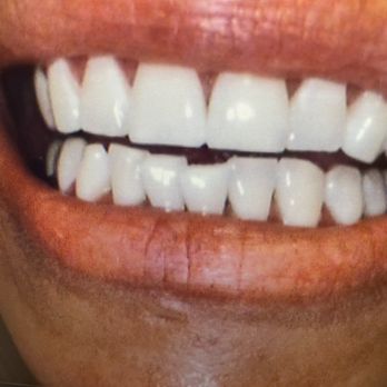 West Coast Dental - Before and after Zoom whitening - Orthodontists Near Me - Rialto, California West Coast Dental - Before and after Zoom whitening - Orthodontists Near Me - Rialto, California