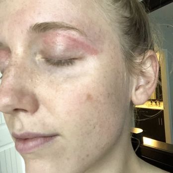 Thread Brow Studio & Salon - Brunt and ripped off my skin during an eyebrow wax - Skin Care Near Me - San Antonio, Texas Thread Brow Studio & Salon - Brunt and ripped off my skin during an eyebrow wax - Skin Care Near Me - San Antonio, Texas