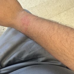 Holiday Inn Express & Suites Globe - Bed bug bites