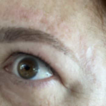 The Body Department - After - Hair Removal Near Me - Scotch Plains, New Jersey