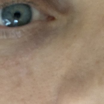 Center for Dermatology & Plastic Surgery - They cut out a hole the size of a dime, no scar - Dermatologists Near Me - Gilbert, Arizona Center for Dermatology & Plastic Surgery - They cut out a hole the size of a dime, no scar - Dermatologists Near Me - Gilbert, Arizona