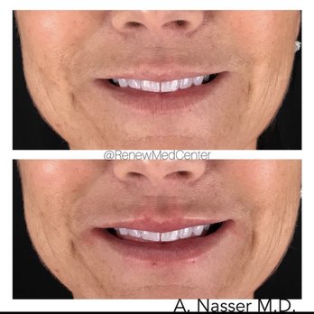 Renew Medical Center - Laser Hair Removal Near Me - Fullerton, California Renew Medical Center - Laser Hair Removal Near Me - Fullerton, California