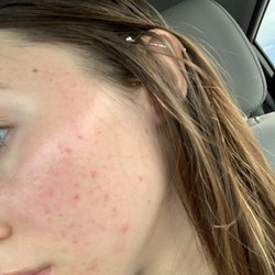 SKIN 101 - Before aerolase.