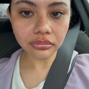 ME Medical Spa - After the lip filler - Medical Spas Near Me - San Jose, California