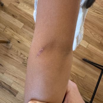 The Cantina - My daughter's 2nd degree burn (a week later) from the kids nachos plate - Mexican Near Me - Mill Valley, California