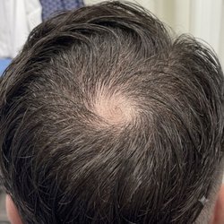 Hair Restoration By Melz