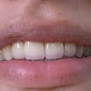 DJ Dental Group - After - Cosmetic Dentists Near Me - La Palma, California DJ Dental Group - After - Cosmetic Dentists Near Me - La Palma, California