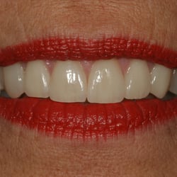 Kathleen McClintock, DDS - Six Porcelain Veneers
