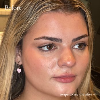 RR Medspa - Before Lip Filler - Medical Spas Near Me - San Diego, California RR Medspa - Before Lip Filler - Medical Spas Near Me - San Diego, California
